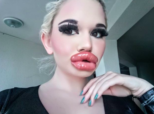 Woman undergoes 20 injectable fillers to achieve 'world's biggest lips'